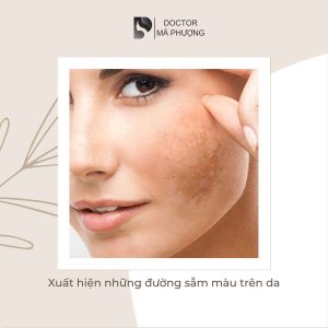 Các sản phẩm chăm sóc nám da giúp da trở nên sáng hơn và mất dần các đốm nâu, các mảng sắc tố trên da