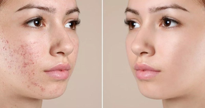 Giai đoạn trị mụn: Các bước quan trọng để đạt hiệu quả cao