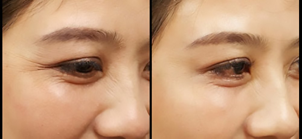 Cách chăm sóc da vùng mắt ngừa nếp nhăn hiệu quả